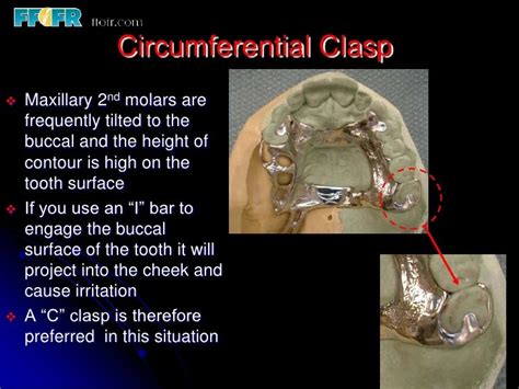 circumferential clasp vs bar.